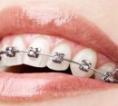 چه دندان هایی نیاز به ارتودنسی دارند؟