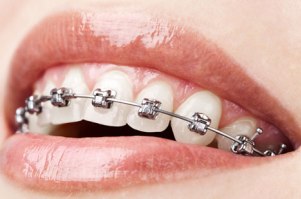 چه دندان هایی نیاز به ارتودنسی دارند؟