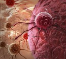 زنان و مردان چه سرطاني را بيشتر مي‌گيرند؟